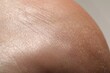 © New Africa - Man with dry skin on his heel against light background, closeup