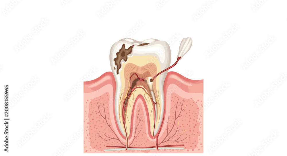 Pulp Caries Medical diagram of a human tooth showing deep dental decay reaching the ...
