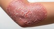 © Dwiyon - Close up of human elbow showing irritated skin texture and red coloration