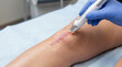 © Guilherme - Cold laser therapy applied to knee surgery scar