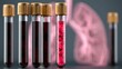 © Suleyman - Blood tube tests for hantavirus sickness in lungs.