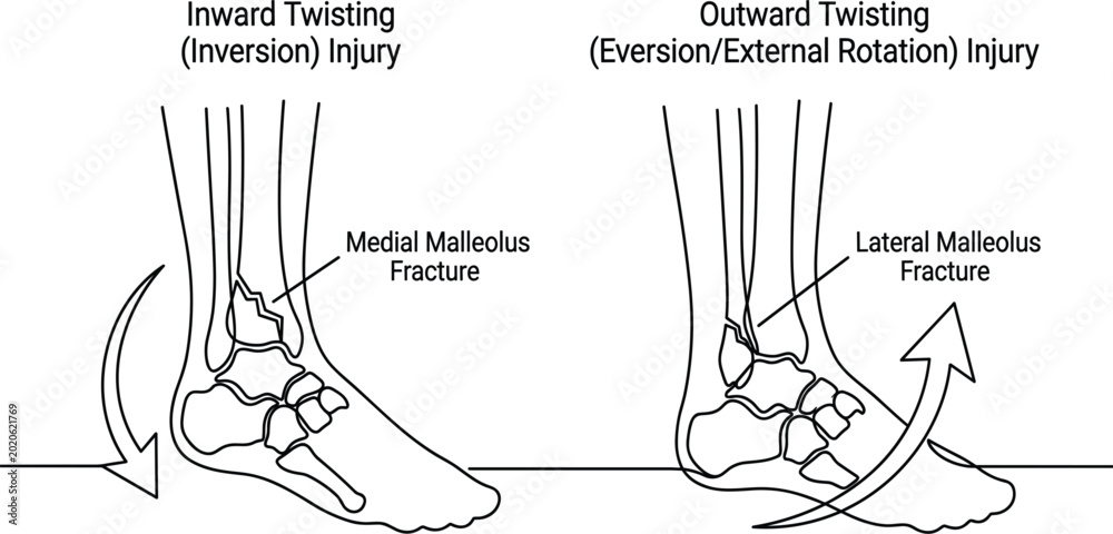 Lateral Inversion Without Label Ankle Fracture Medical Illustration Showing Inversion and Eversion ...