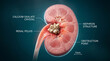 © Viskia - Nephrological pathology showing a calcium oxalate calculus blocking the renal pelvis for clinical urology diagnostics and surgical education resources.