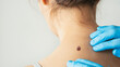 © sebra - Examining skin for potential cancerous growths
