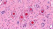 © Amna - Herpes Simplex Virus Cowdry A Inclusion Bodies H&E Neuron. Cowdry type A intranuclear inclusion bodies in neurons from H&E stained brain tissue in herpes simplex encephalitis.