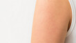 © Victoria - woman arm with keratosis pilaris showing skin texture and bumps. Medical dermatological condition on shoulder. Skin health problem and skincare concept for body treatment and dermatology