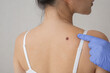 © Mimi - Examining skin for potential cancerous growths