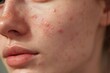 © Smart Future - A woman with acnes on her face. She has a serious look on her face.