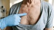 © Prageeth - Macro Close Up of Heart Bypass Surgery Chest Scar with Pointing Finger for Cardiac Rehabilitation Concept