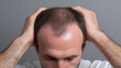 © A2Z AI  - Concerned male experience hair thinning and hair loss, hands on head, focus on receding hairline and baldness, men's aesthetic issue