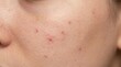 © hanifah - Close up of acne on skin causing inflammation and irritation