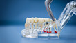 © Maximusdn - Transparent dental teaching model of the jaw with tooth pathologies, cysts, and surgical forceps on a blue background. Tooth extraction concept.