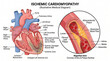 © LAKY - Medical diagram of ischemic cardiomyopathy and coronary artery