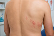 © snesivan - Herpes zoster rash on human torso in clinical examination setting