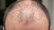 © mohamed - Close-up View of Male Scalp with Thinning Hair and Receding Hairline in Natural Light. Generated with AI image