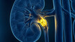 © Brata - Anatomical 3D medical illustration of a human kidney cross-section showing a glowing yellow stone lodged in the ureter causing urinary obstruction.