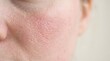 © Shraddha - Close up of skin showing symptoms of redness and dryness on the cheek