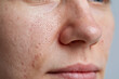 © JoeyMarut - Macro close up of facial skin with visible acne scars, enlarged pores and textured nose conveying natural skin detail and subtle emotion