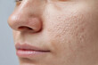 © JoeyMarut - Macro close up of facial skin near nose and cheek showing atrophic acne scarring and textured pore detail with natural skin tone and soft lighting