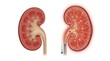 © Jayk - Illustration comparing a healthy kidney to a kidney with stones and inflammation