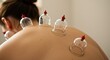 © logitech - Person receiving cupping therapy on back with suction cups applied