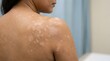 © SaifulAziz - Hypopigmented skin patches on a person's back and shoulder, a dermatological condition like Tinea Versicolor or Pityriasis Versicolor, showing skin...