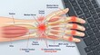 © tech_with_mayur - Anatomical illustration of human wrist showing median nerve, carpal tunnel, flexor tendons with glowing red inflammation points beside computer keyboard representing repetitive strain injury