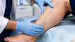 © Victoria - phlebologist examining woman leg with varicose vein. Doctor checking spider vein on patient limb in medical clinic. Venous insufficiency treatment and vascular disease diagnostics
