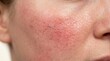 © cong - Close up of severe rosacea with broken capillaries and facial redness on cheek