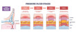 © VectorMine - Pressure ulcer stages infographic illustrating progressive skin breakdown from prolonged pressure, shows heel, skin layers, and mattress pressure point. Outline diagram