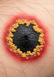 © Hungarian - Macro View of a Severe Skin Lesion with Black Necrotic Center and Inflamed Red Border for Medical Education