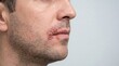 © Li - Close up of male mouth with herpes simplex virus infection and painful cold sores on lips
