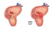 © logitech - Medical illustration compares a healthy prostate gland with a tumor, highlighting anatomical differences in human male reproductive system.