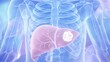 © 程 加星 - Medical anatomical diagram displaying malignant hepatic tumor lesion and liver cancer mass inside human liver, abdominal CT radiology artwork for hepatology oncology clinical diagnosis analysis