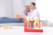 © New Africa - Dental implant models on desk. Dentist with patient in clinic, selective focus