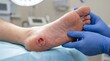 © Pixim Stock - Doctor examining deep wound on patient's heel, close-up of medical care for foot ulcer, podiatry consultation for diabetic foot injury, wound care treatment, medical examination.