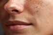 © Kucraft Creator - Chin Blemishes and Acne Prone Skin