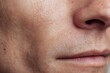 © Kucraft Creator - Facial Skin Showing Whiteheads and Minor Blemishes
