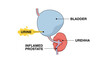 © Mahin - Medical anatomical diagram detailing the male bladder urethra and urine blockage due to an inflamed prostate.