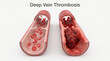 © Mohamed - Deep Vein Thrombosis Blood Clot DVT Medical Illustration