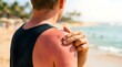 © your picture - Male traveler checking painful sunburned shoulder on summer beach representing uv skin damage and neglected sun protection warnings
