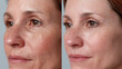 © iconic - A split image shows an older woman's face before and after treatment, demonstrating a reduction in wrinkles and age spots for a more vibrant look.