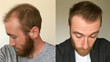 © iconic - A diptych displaying a man's receding hairline before and after a hair restoration treatment, illustrating significant hair regrowth and improved density.