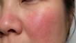 © sknab - Close-up of female face with red irritated skin on cheek showing natural skin texture and pores