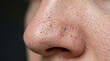 © troxxx - Close-up of human nose skin texture showing blackheads and enlarged pores on skin