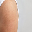 © sknab - Close up of human upper arm skin with visible small bumps and hair follicle redness