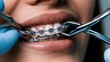 © 69 - Close up of dental professional adjusting metal braces on healthy teeth of patient with blue gloves during orthodontic treatment session