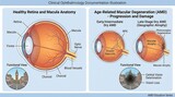 Clinical illustration of age-related macular degeneration progression from healthy retina to early and late-stage dry AMD, featuring macular atrophy and simulated central vision loss effects.
