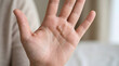 © DI LAB - Human hand showing viral warts on palm. Close up of skin condition and dermatological issue.