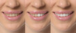© New Africa - Collage showing smiling woman before and after teeth whitening, closeup